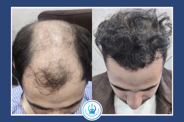 Hair Transplant in Kathmandu Before After