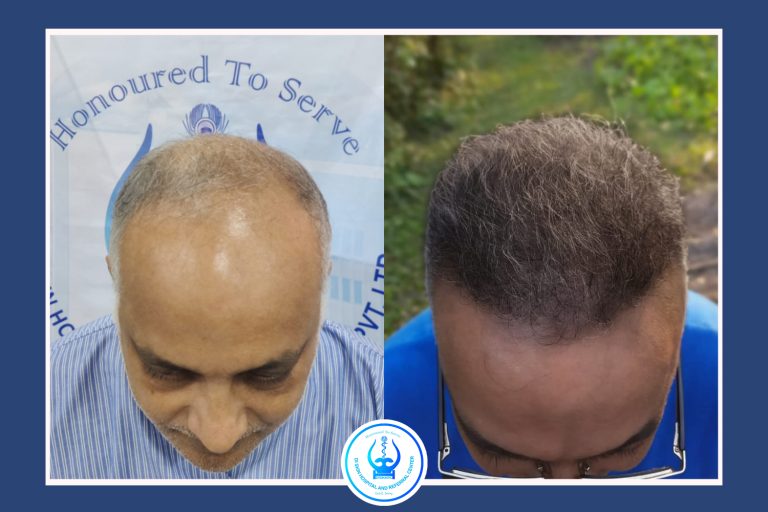 Hair Transplant in Kathmandu Before After