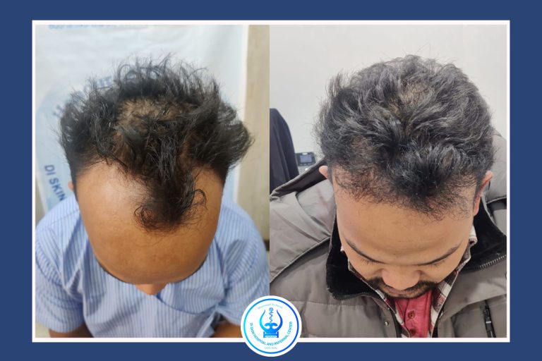 Hair Transplant in Kathmandu Before After