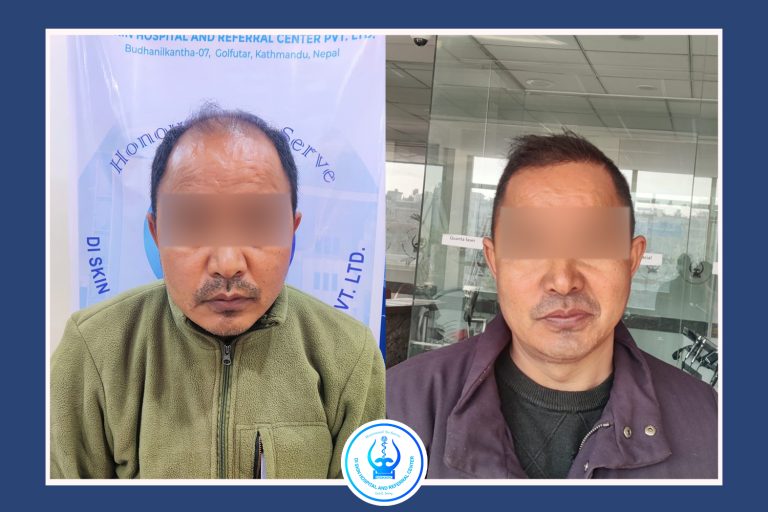 Hair Transplant in Kathmandu Before After